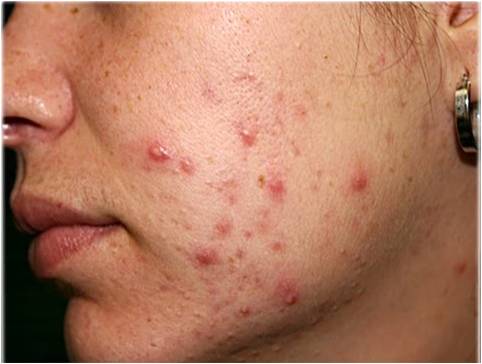 acne treatment in Gurgaon
