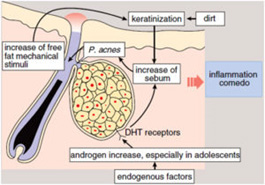 pimples treatment in Gurgaon