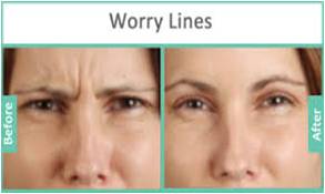 botox treatment in Ggurgaon